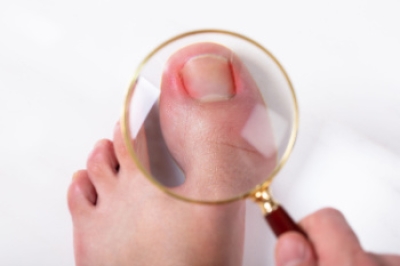 Symptoms and Relief Options for Ingrown Toenails