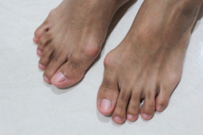 What Causes Bunions?